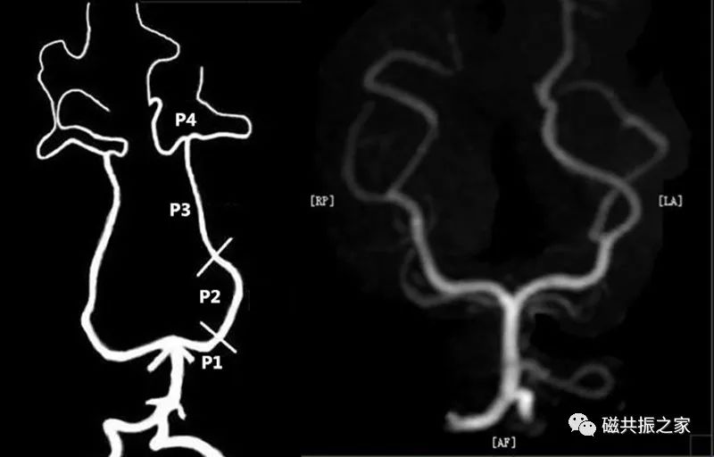 颅内mra解剖及其分段
