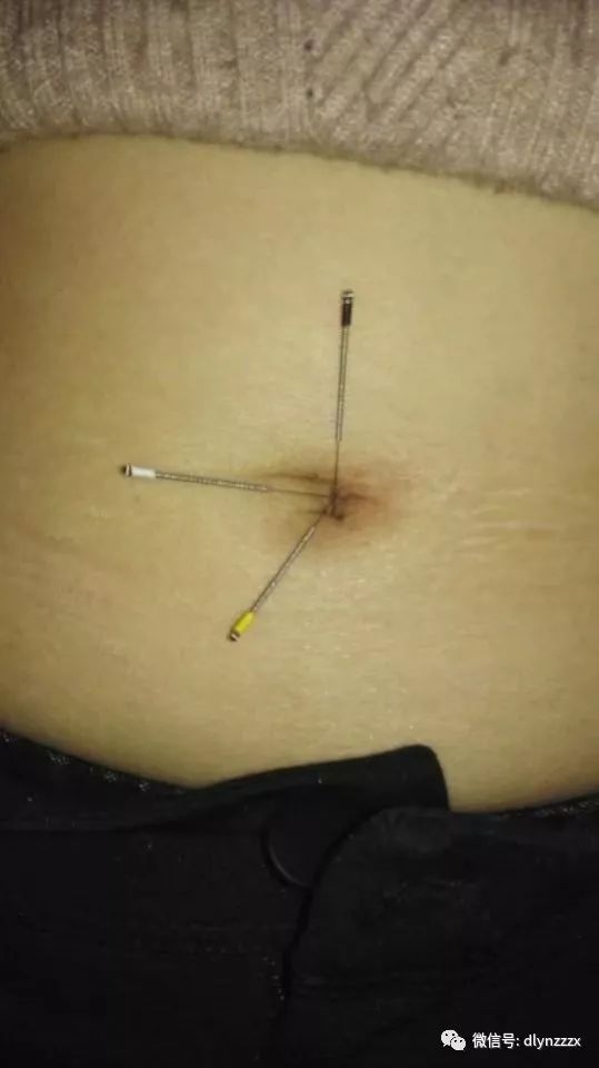 脏腑功能下降,所以用四正位 四隅位调整全身,脏腑,然后在用补肾三针