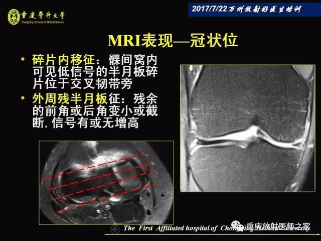 早读| 膝关节损伤的磁共振诊断要点