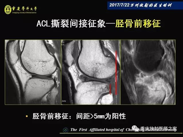 早读| 膝关节损伤的磁共振诊断要点
