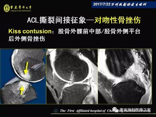 早读| 膝关节损伤的磁共振诊断要点