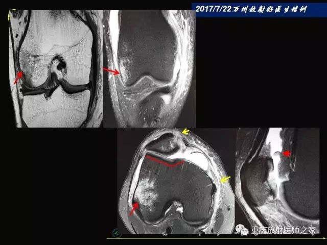 早读| 膝关节损伤的磁共振诊断要点