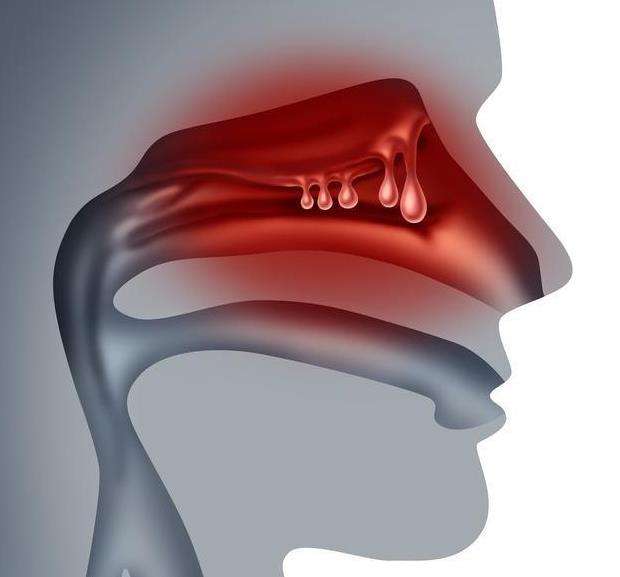 鼻息肉流鼻涕鼻子堵塞一味中药化解免费分享