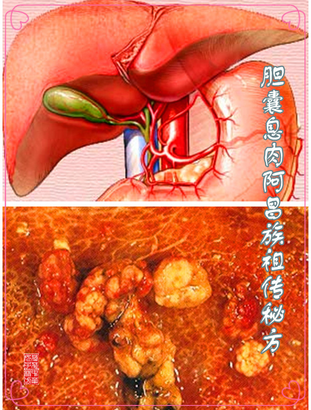 胆囊息肉阿昌族祖传秘方