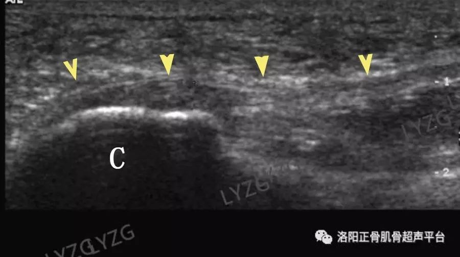 足底跖腱膜炎的超声表现