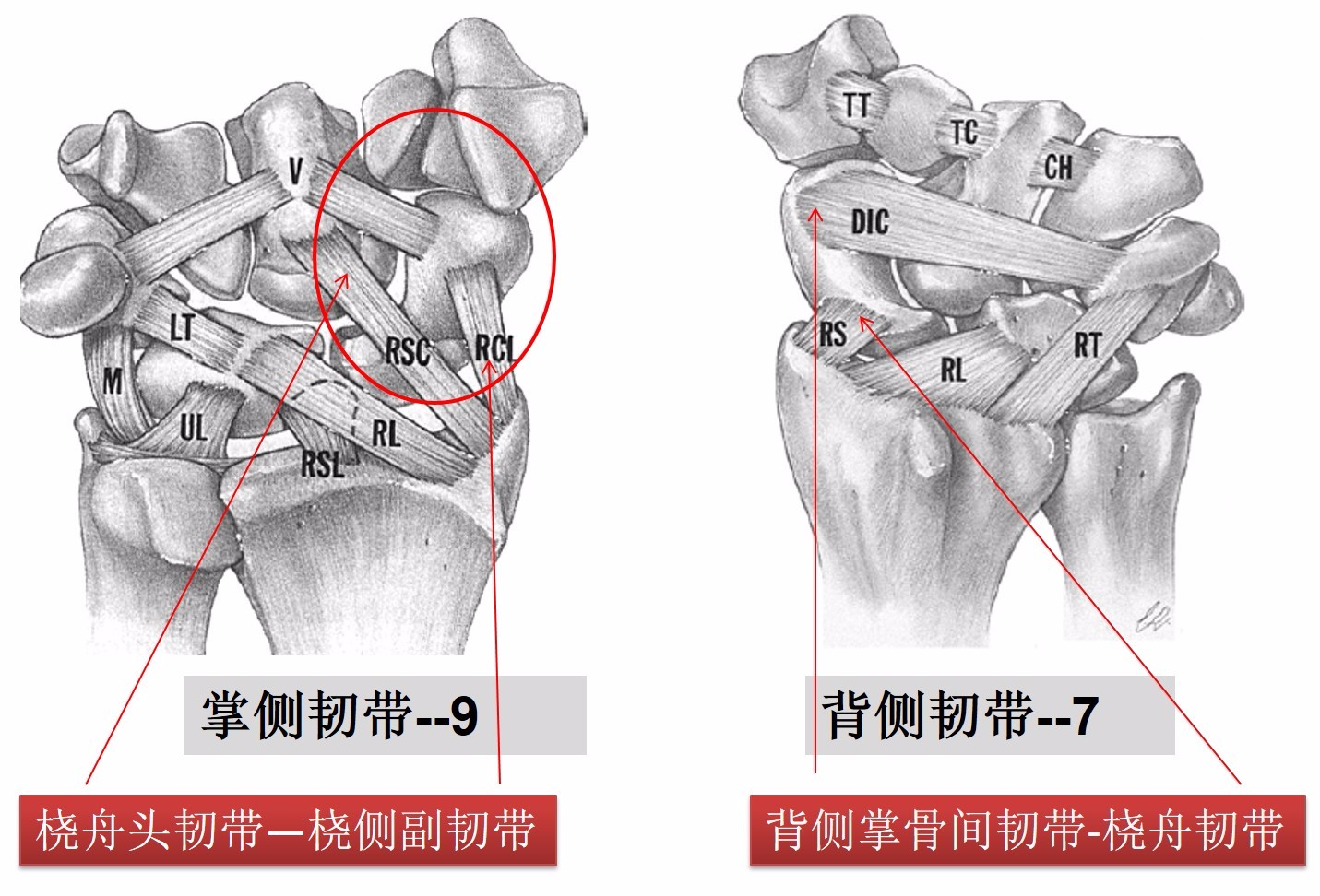 专题教程:舟状骨骨折的7种手术入路详解