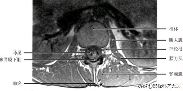 腰椎磁共振横断面
