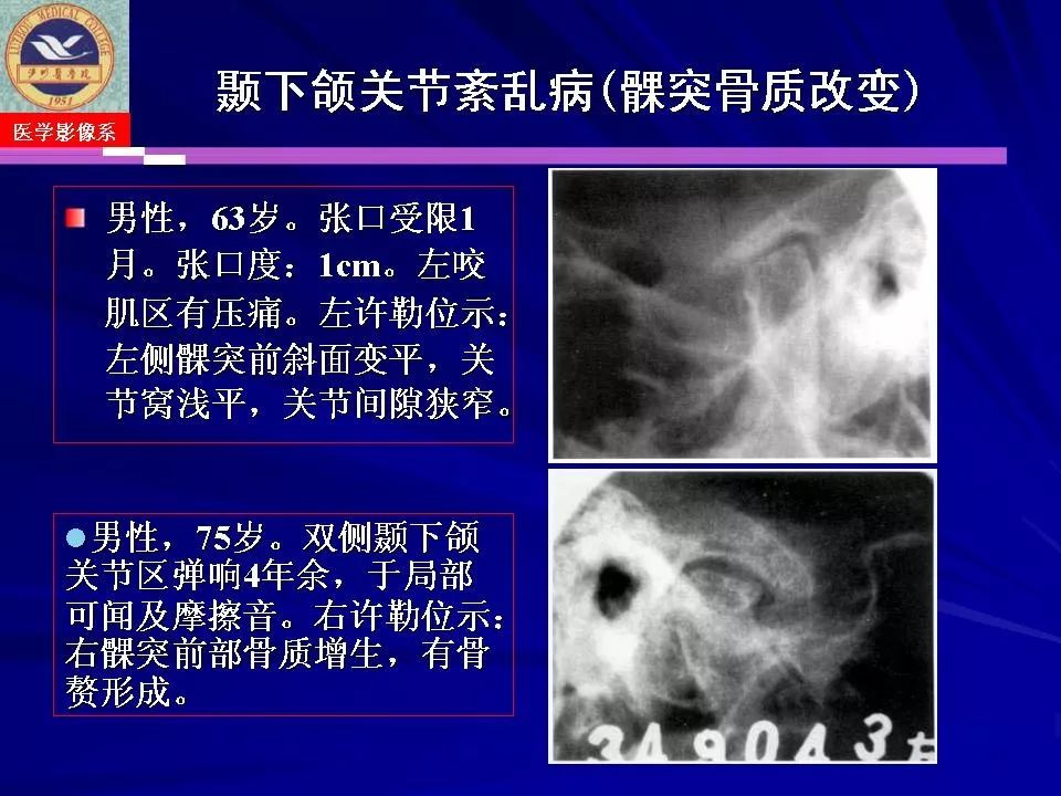 颞下颌关节疾病影像诊断丨影像天地