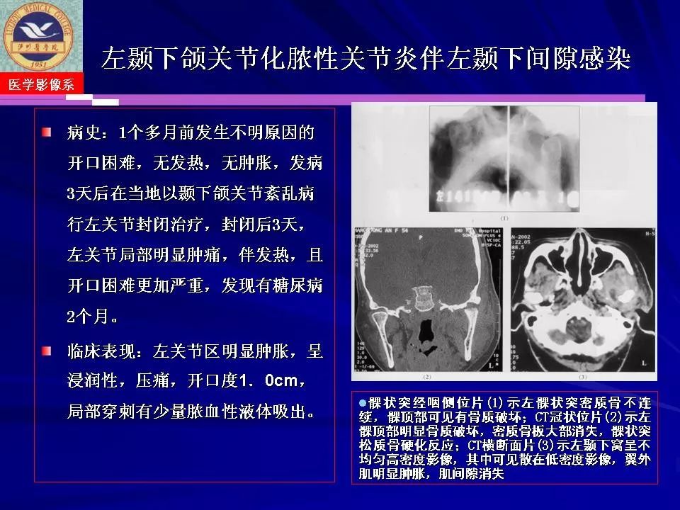 颞下颌关节疾病影像诊断丨影像天地