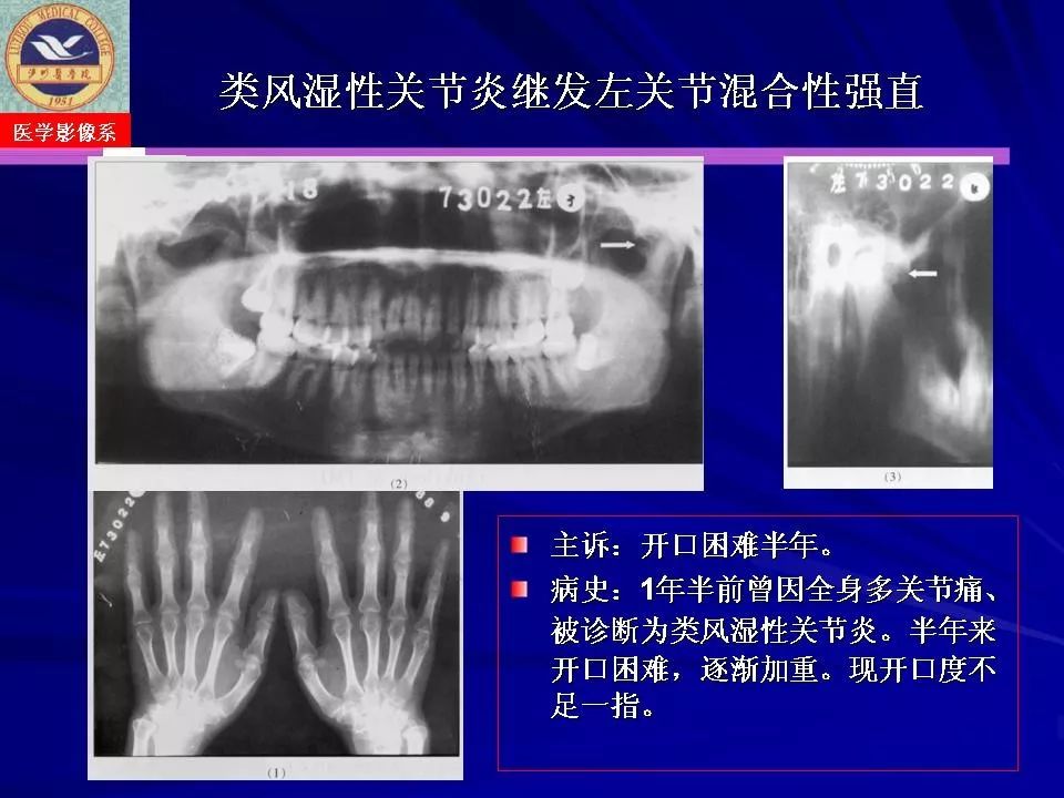 颞下颌关节疾病影像诊断丨影像天地