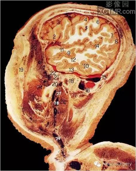 经典颅脑断层解剖图——矢状位