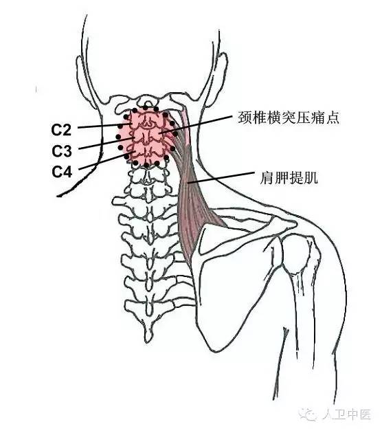 颈椎棘突压痛多见于棘上韧带亦称项韧带,压痛常见于颈椎3,4,5,6的棘突