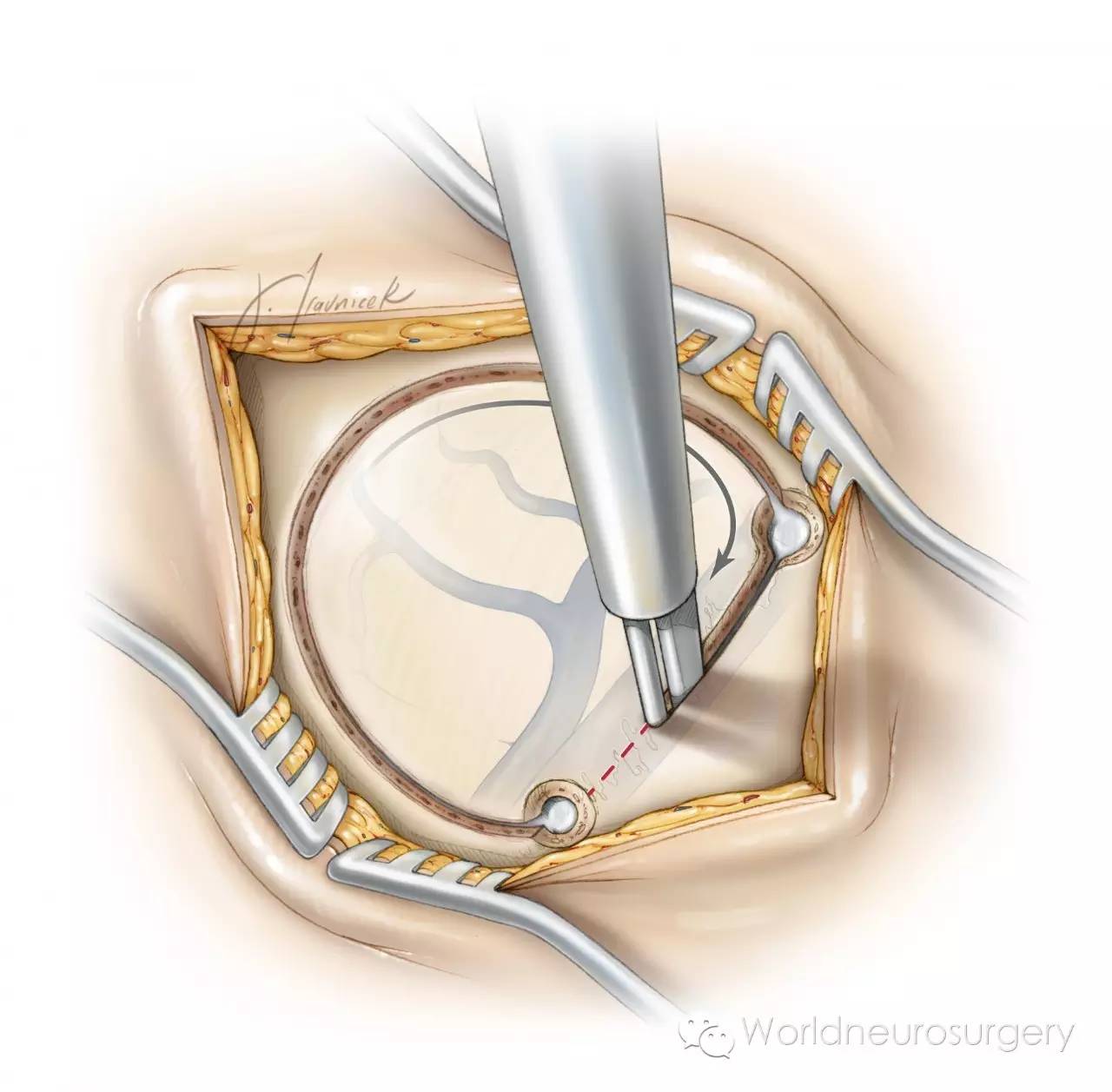 基础开颅技巧之钻孔与骨瓣形成
