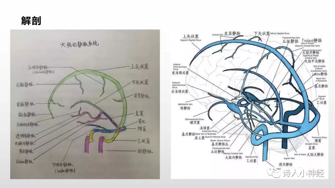 颅内静脉血栓形成(cvt)