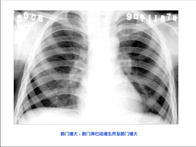 照片名称:肺门增大