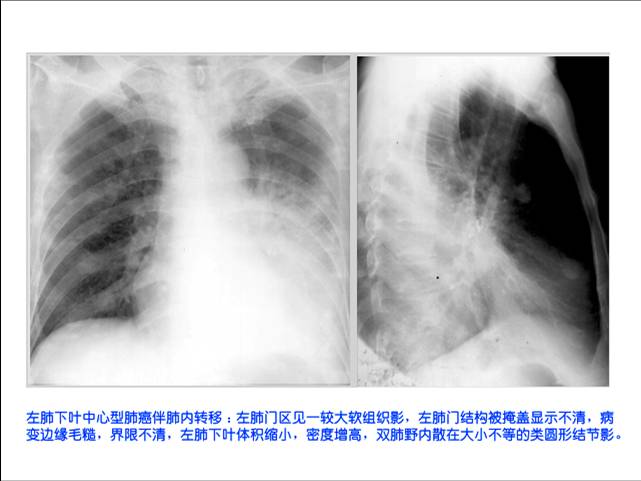 照片名称:二尖瓣狭窄瓣关闭不全