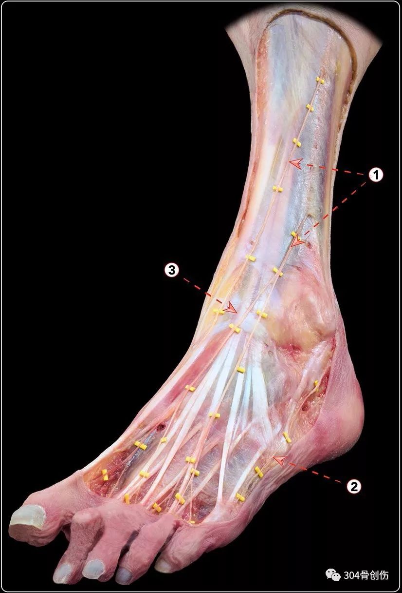 踝关节不稳定(4)-踝伸肌下支持带解剖