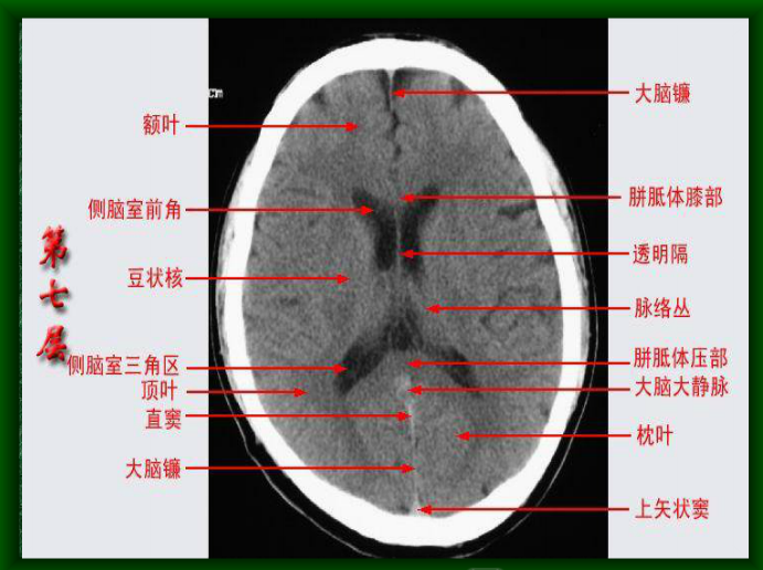 颅脑ct彩色图谱——脑叶解剖  第五脑室,第六脑室以及中间帆腔(图文