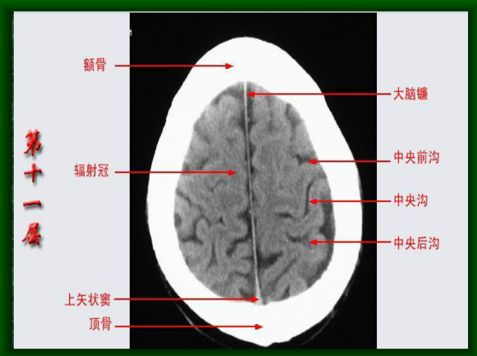 图文详解垂体之死  颅底的主要孔道及内容物  颅脑ct解剖对照图  半