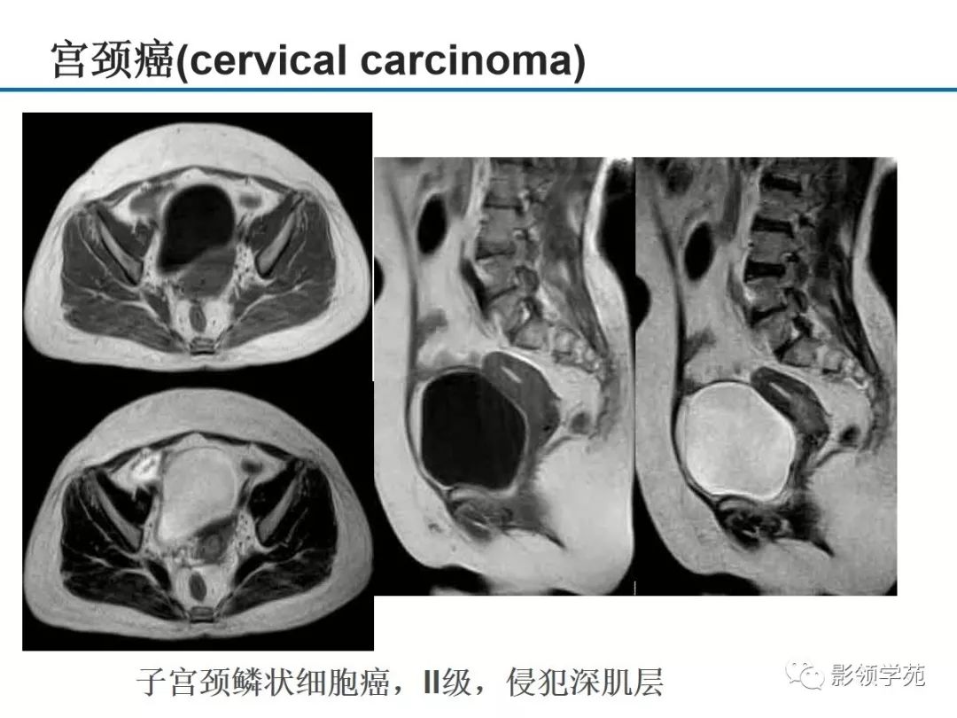 女性盆腔疾病的mri诊断