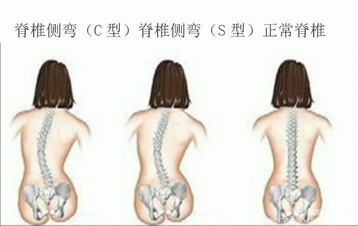 脊椎侧弯(c型,s型) (附脊柱侧弯矫正操)