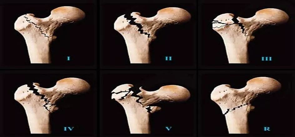 Ⅱ型:移位合并小转子撕脱骨折,但股骨距完整(股骨距是位于小转子深部