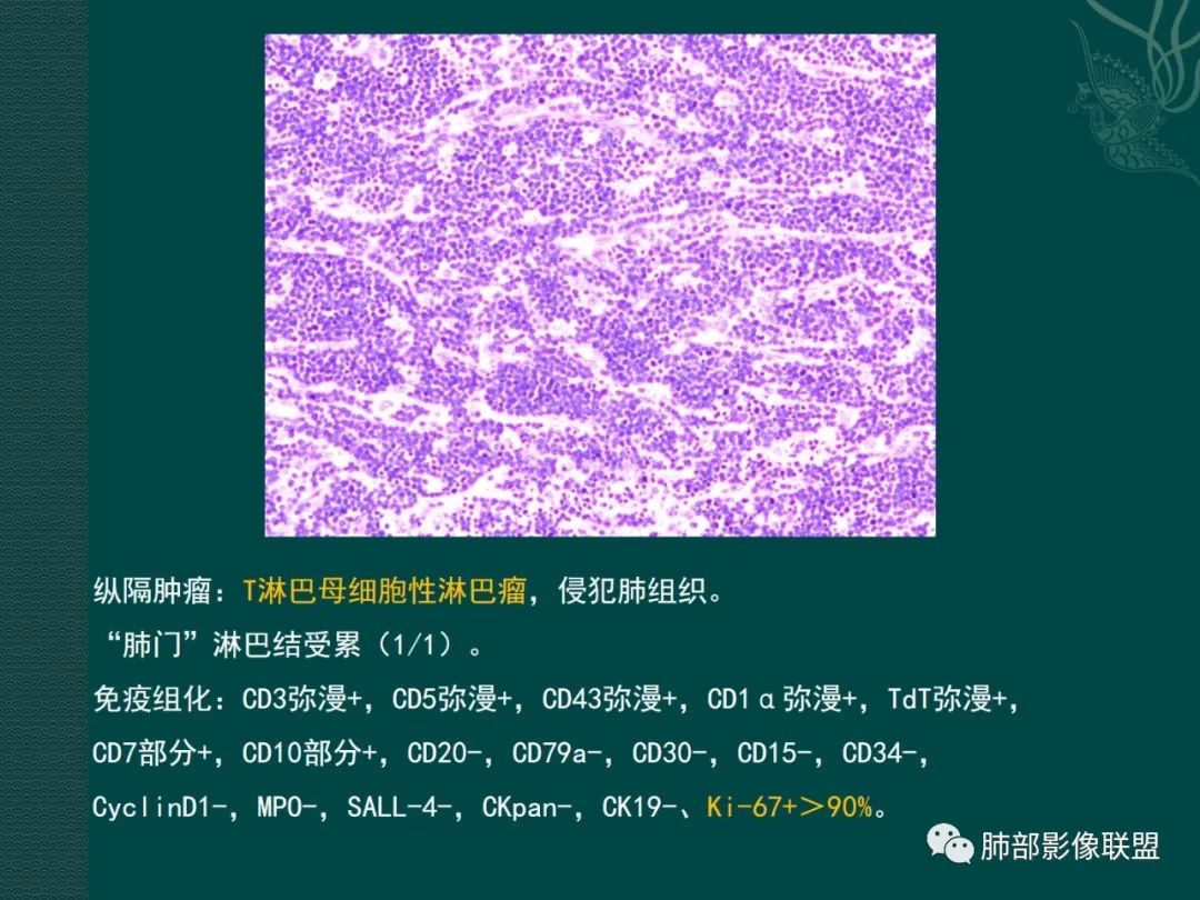 【黄勇专题讲座】胸腺淋巴瘤的影像诊断
