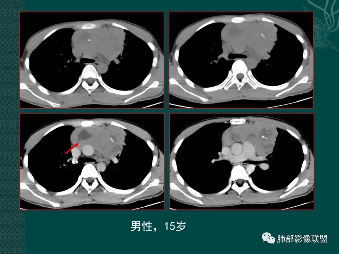 胸腺淋巴瘤的治疗与胸腺瘤,生殖细胞肿瘤天壤之别.