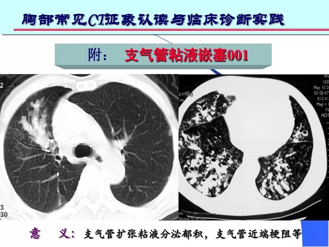 边界可清晰也可不清晰,透过其中可显示肺纹理影,有时可见空气支气管征