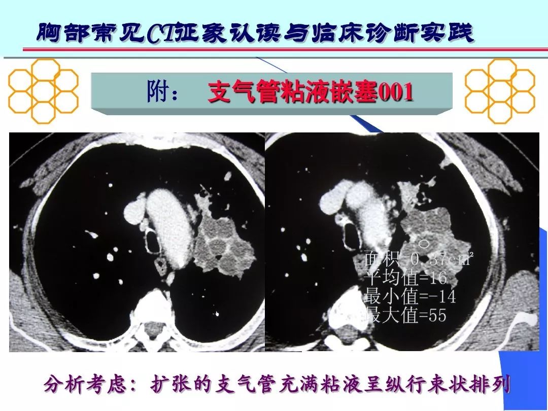 意义:  表明有支气管扩张分泌粘液,支气管近端有梗阻粘液不能排出