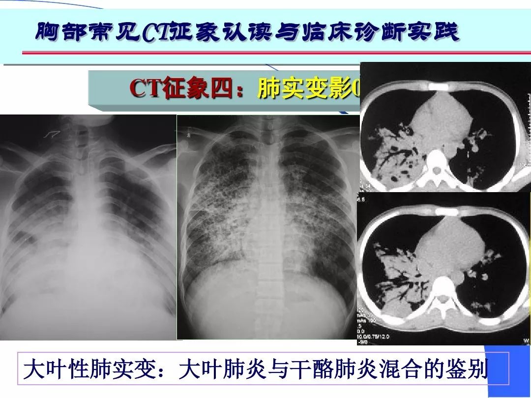 ct表现为:  形态与大小不一的很高密度影,边界多不清,累及大叶时叶