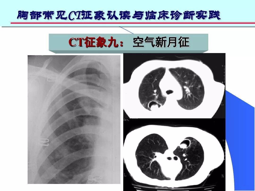 影像学基础丨肺部ct常见10大征象诊断应用
