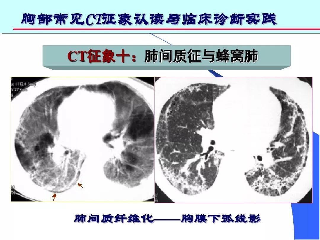 影像学基础丨肺部ct常见10大征象诊断应用
