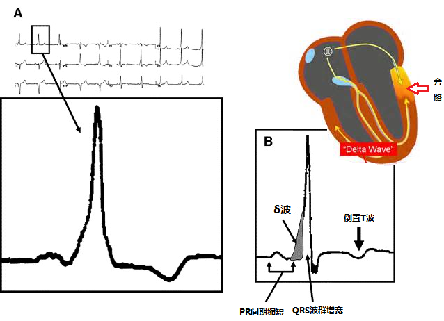 δ波(delta波)多出现在经典的预激综合征(wpw综合征),此类患者的