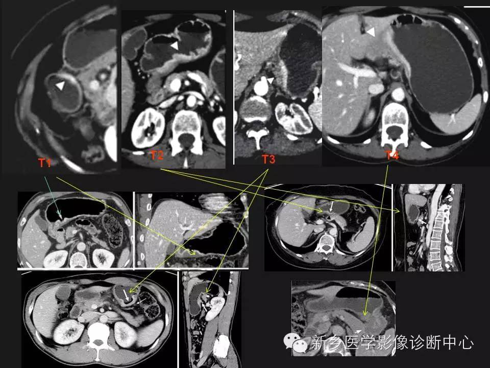 分期胃癌的影像学分期图解