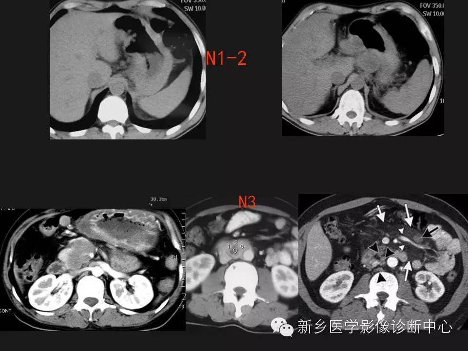 分期胃癌的影像学分期图解