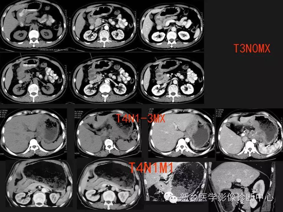 【分期】胃癌的影像学分期图解