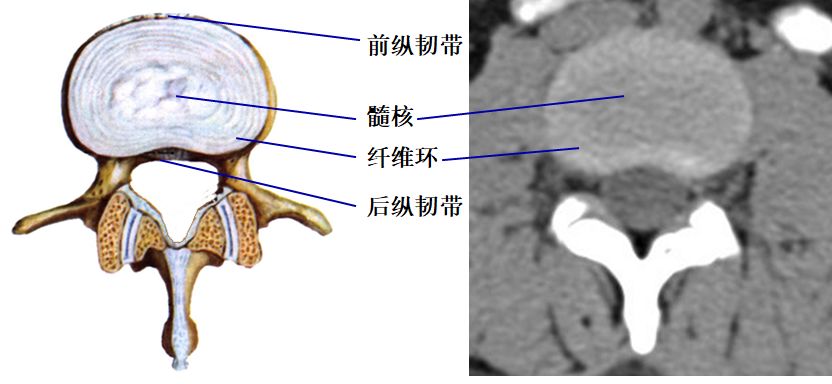 椎弓间的连结    包括椎弓板间,棘突间和横突间的韧带及上,下关节突间
