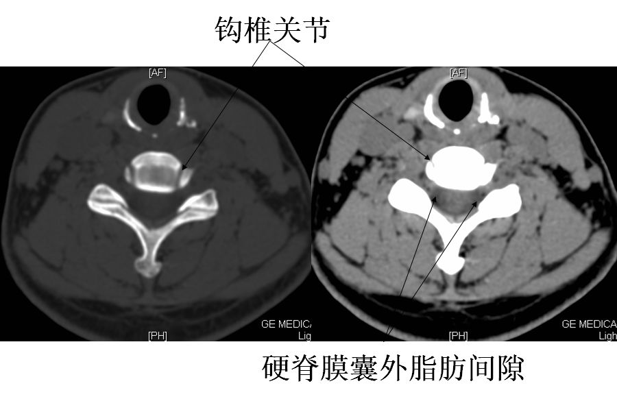 椎间孔前后径小,钩椎关节增生时易刺激神经根.