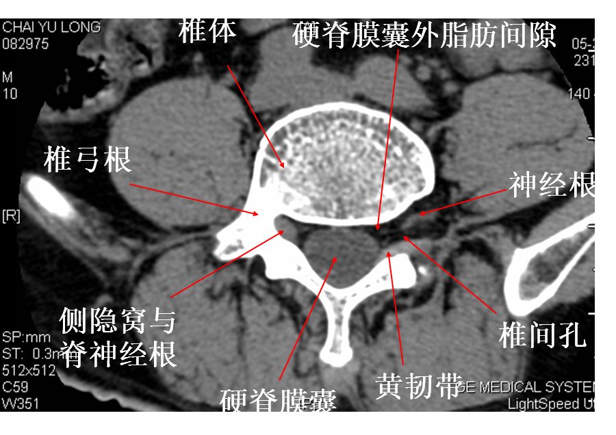 正常前后径为3-5mm, 3mm侧隐窝狭窄>5mm,肯定不狭窄.