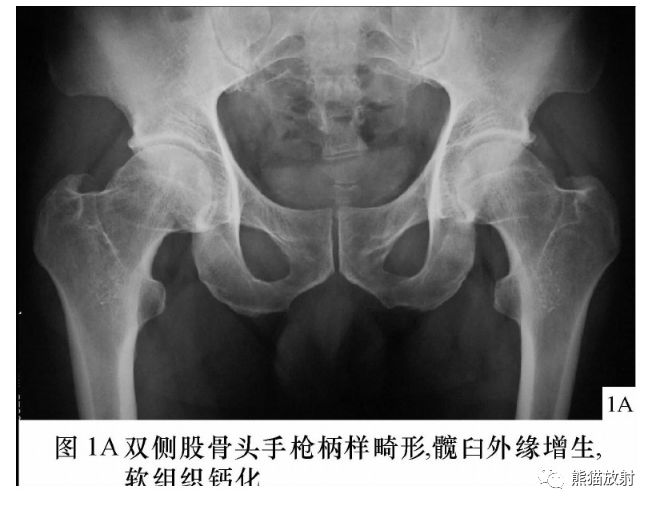 偏心距 ↓α 角 ↓lce角 ↓pincer型:x线表现髋臼过深,前突,后倾ct