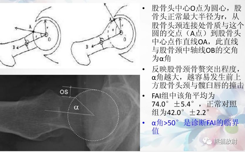 lce角↓pincer型:x线表现髋臼过深,前突,后倾ct扫描cam型pincer型mri