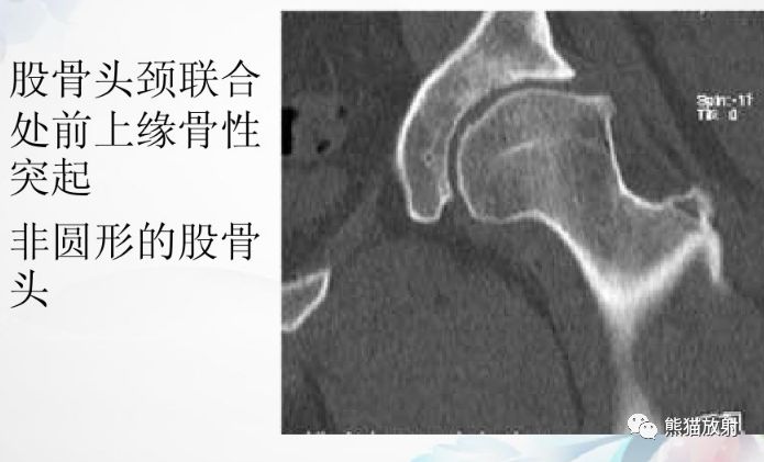 多见于年轻人(20-40岁,女性多见,与股骨头和髋臼的先天发育有关