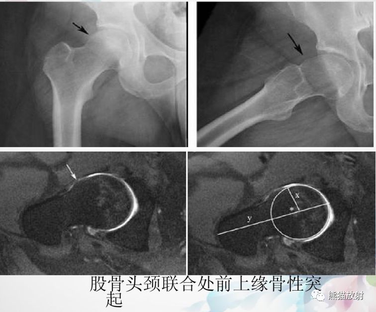 多见于年轻人(20-40岁,女性多见,与股骨头和髋臼的先天发育有关