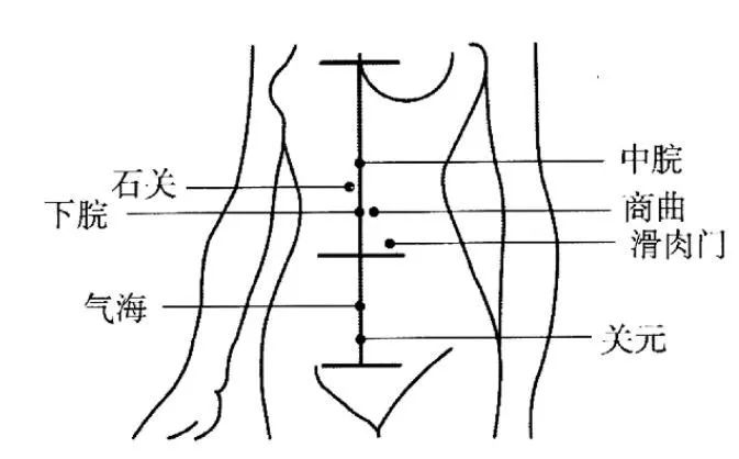 如何运用腹针治疗偏头痛   主穴(君,臣):引气归元(即中脘,下脘,气海