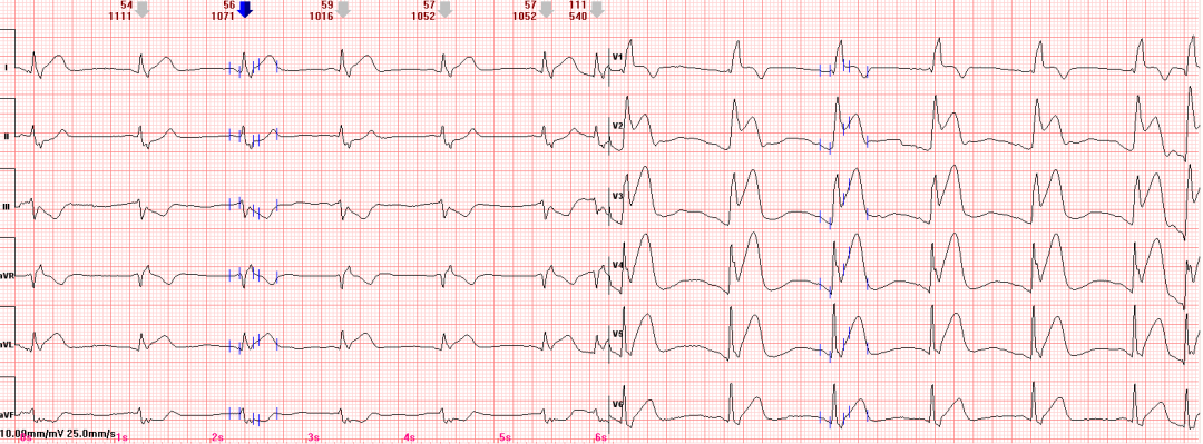心电图示胸导联t波高尖,振幅>10mv,t/qrs>3/4,基底增宽,考虑超急性期t