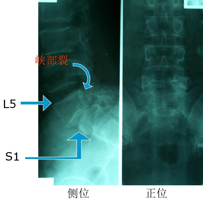 腰椎滑脱的影像学表现及治疗全在这里了