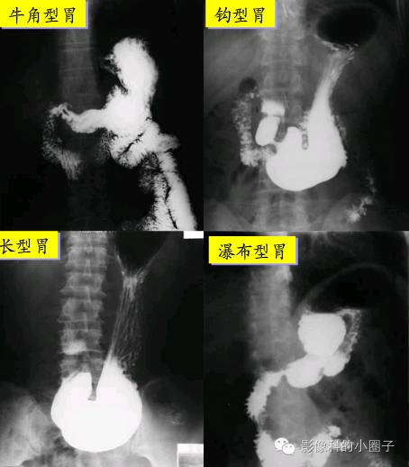 贲门→角切迹长型胃(无力型):瘦长体型,张力低,上窄下宽,犹如水袋,胃