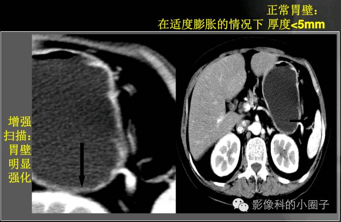 消化道正常影像解剖之——胃