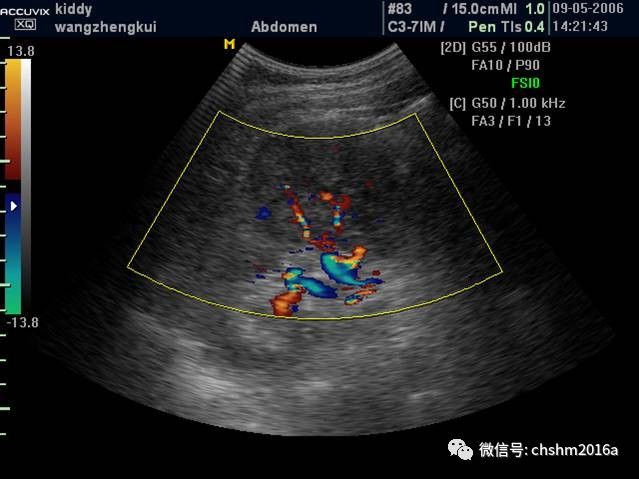 肾肿瘤超声鉴别诊断